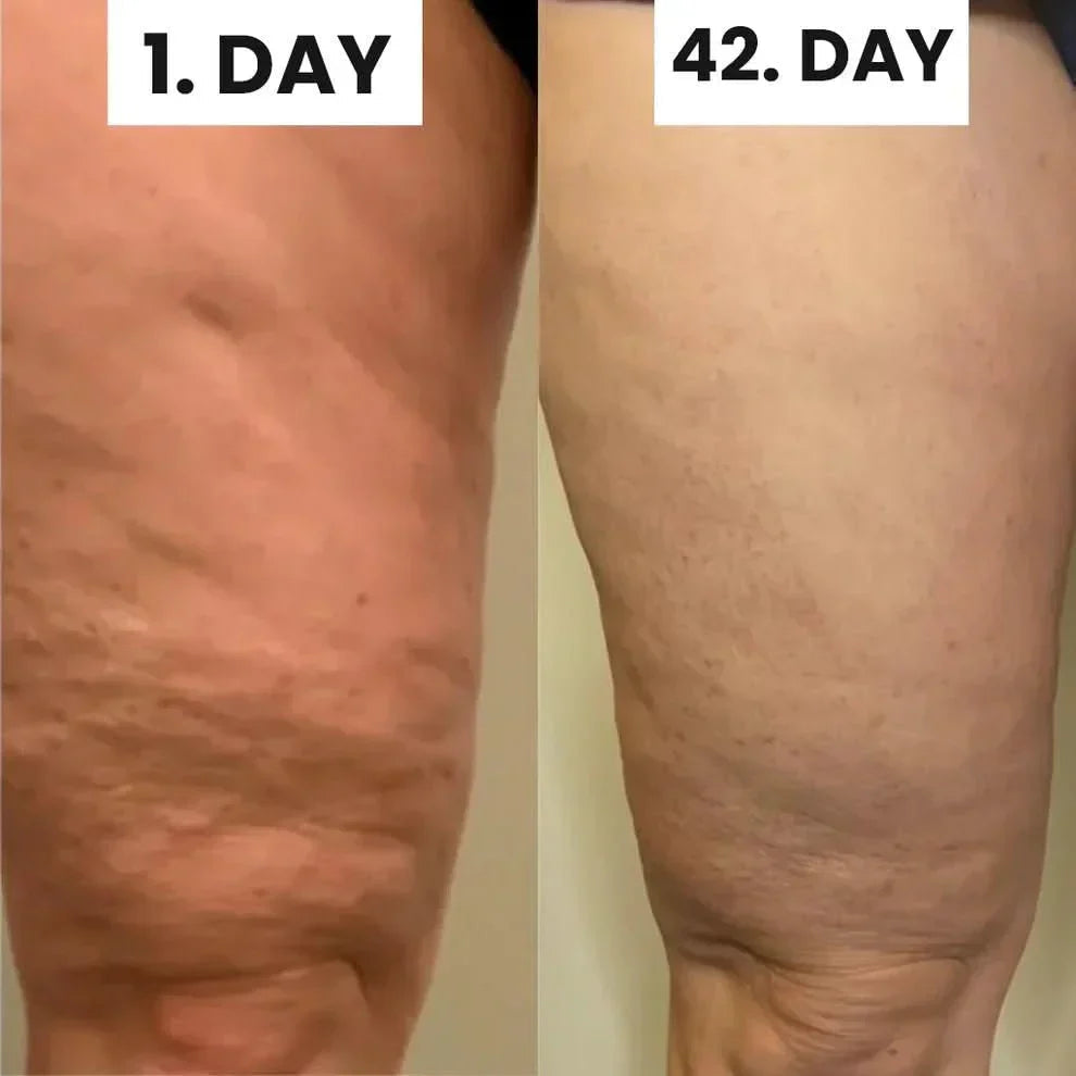 Wellness™ Cellulite Relief Kit
